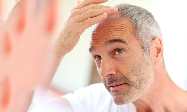 Soluciones para los problemas de caída de cabello