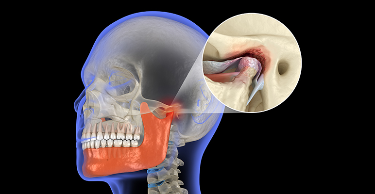 articulación temporomandibular consejos cuidado